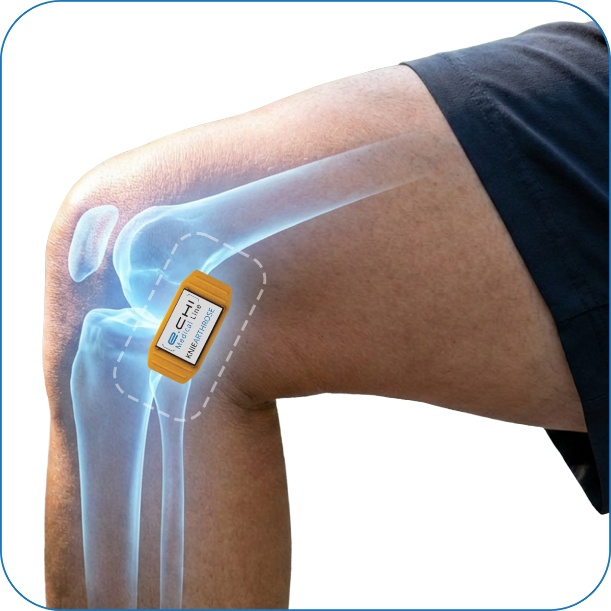 KnieArthrose Medizinprodukt – Bild 2